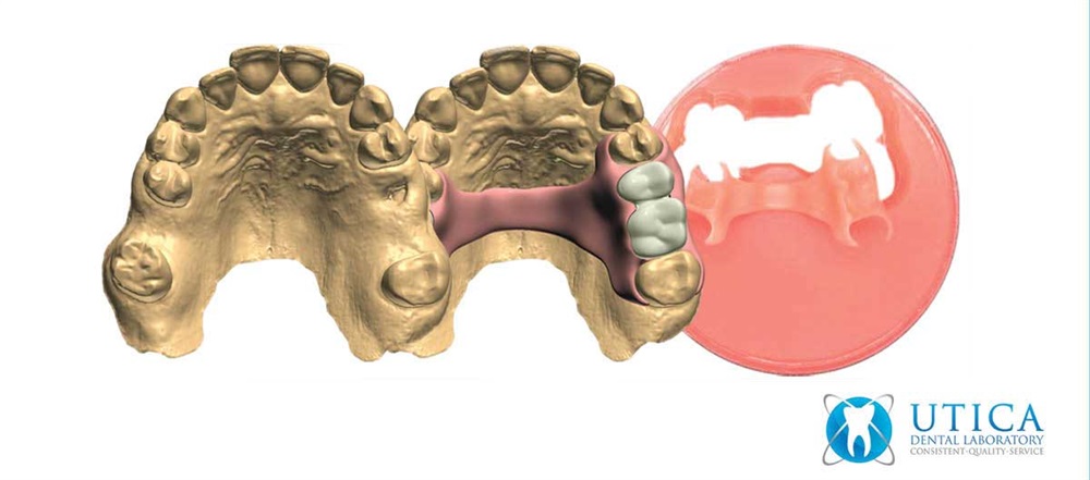 Product Profile: TCS 3D Flexible Partials